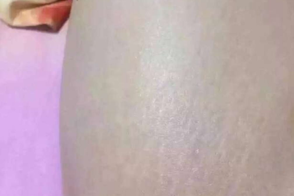 激光去除肥胖纹后