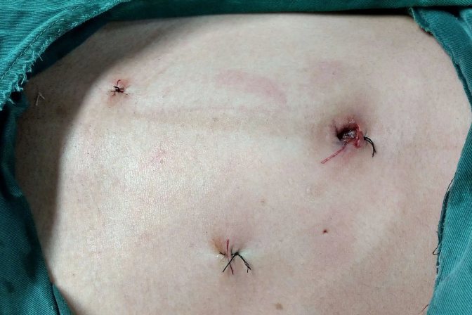 微创手术伤口真实图片