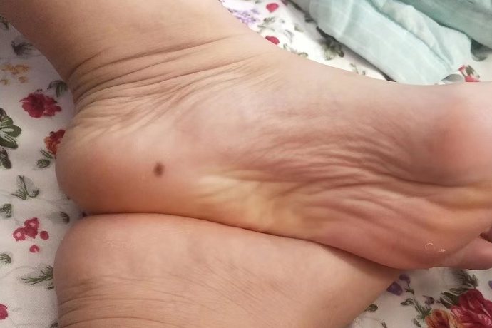 脚底黑色痣