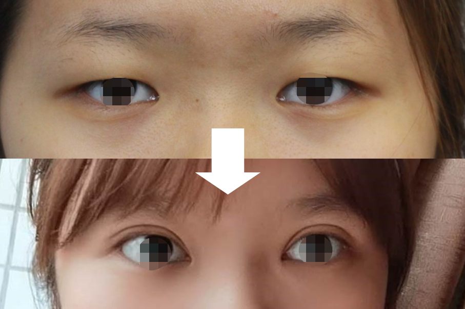 肉眼泡割出来双眼皮图片