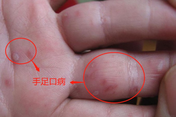 手足口病图片