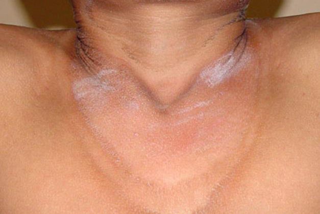 糙皮病初期症状