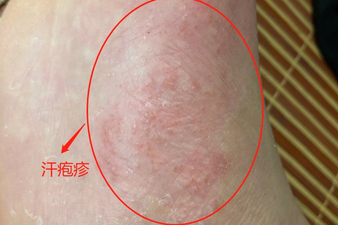 脚上汗疱疹图片