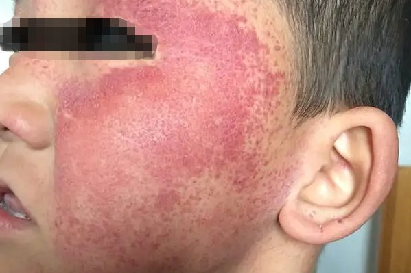 特发性血小板减少性紫癜