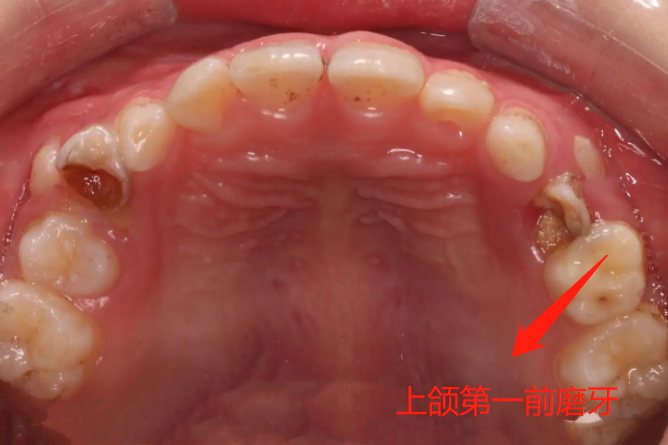 上颌第一前磨牙
