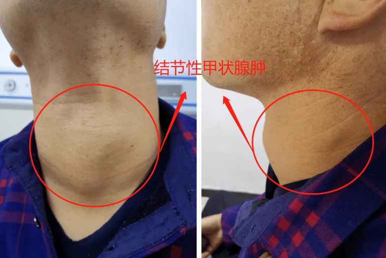 结节性甲状腺肿