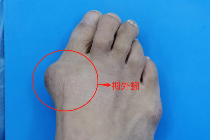 拇外翻图片