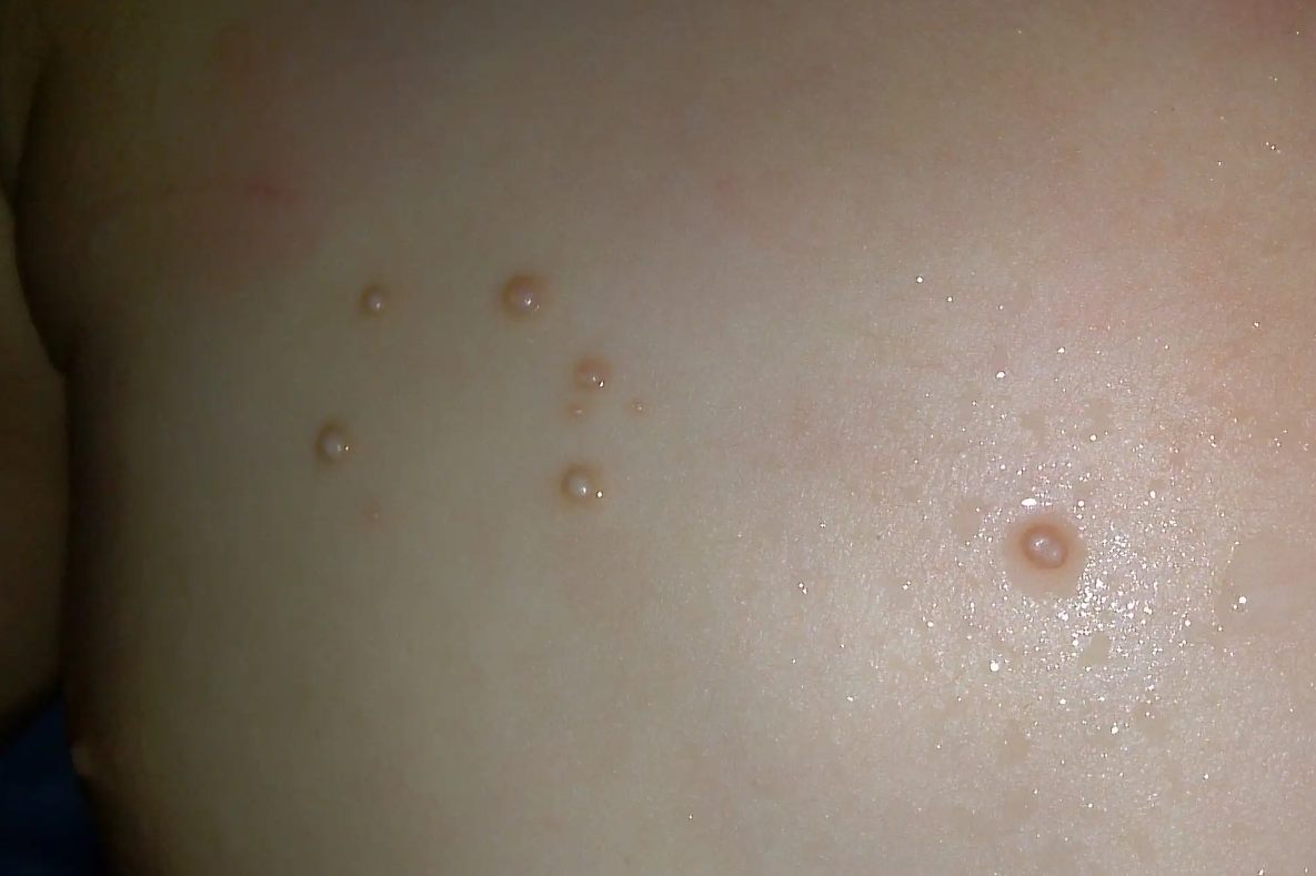 初期传染性软疣