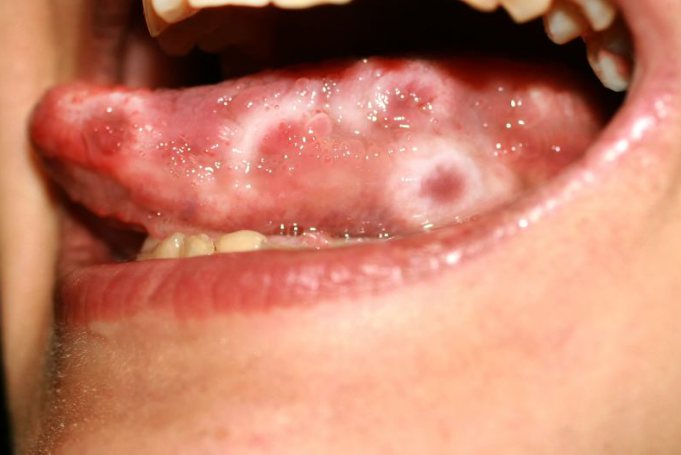 浸润性舌癌早期图片