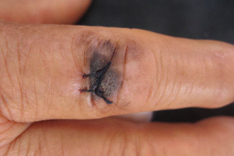 肢端雀斑样黑素瘤