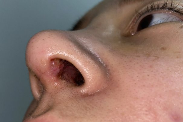 隆鼻后鼻孔内假体外露图片