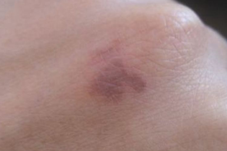 皮肤抓破后的黑疤