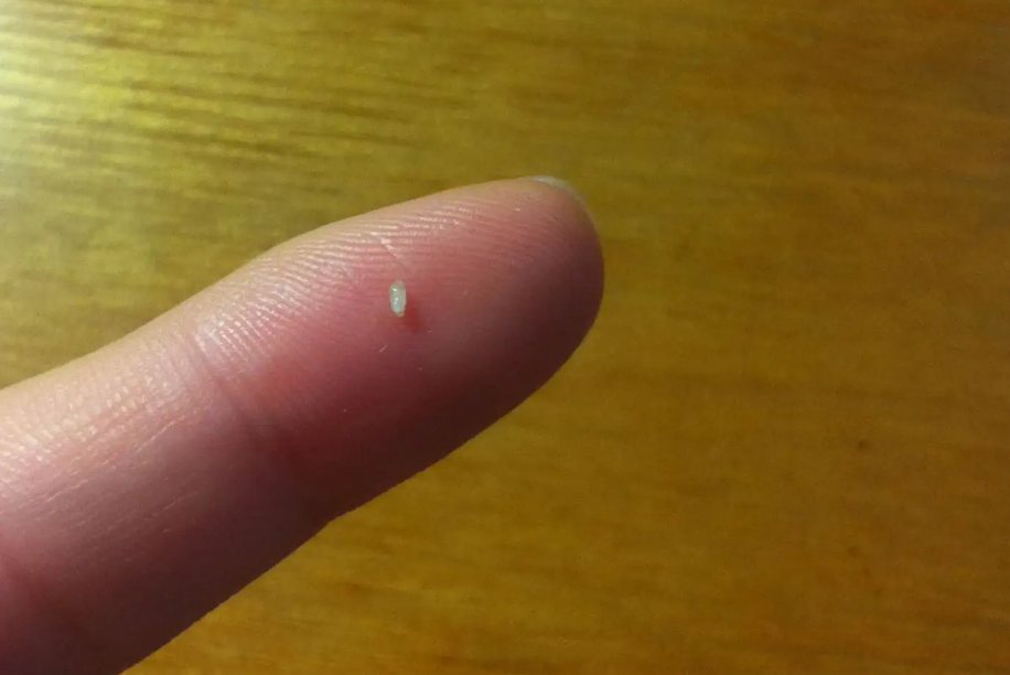 痘根取出后外观