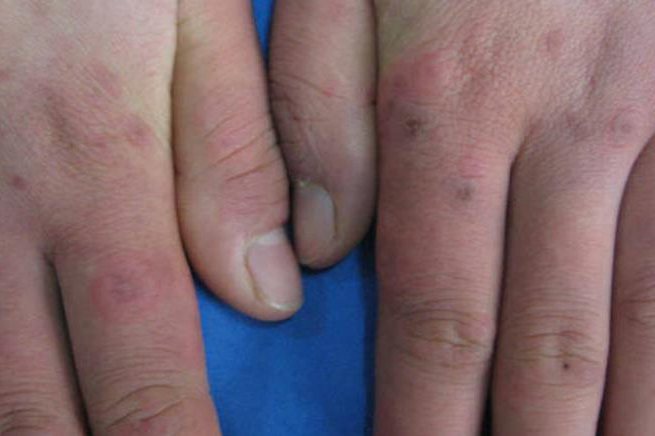 寒冷性多形红斑