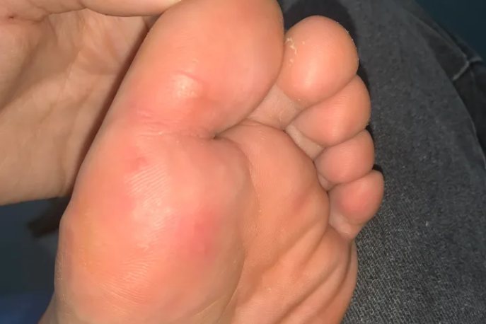 液氮冷冻老茧图片