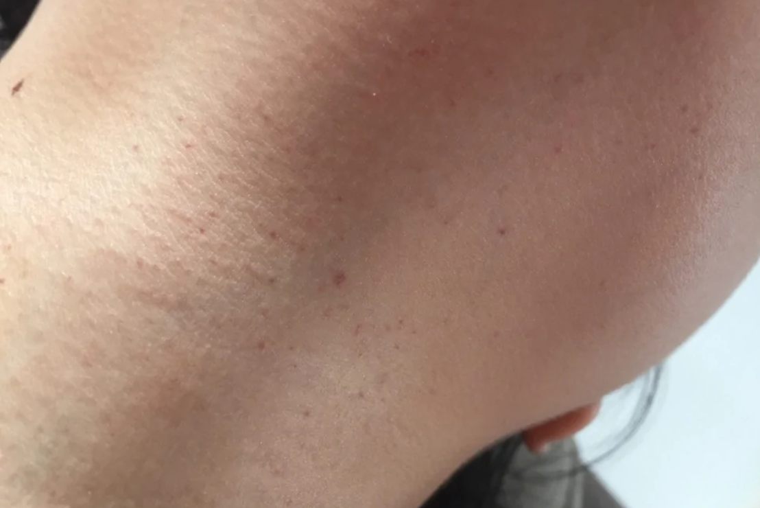 血小板减少性紫癜