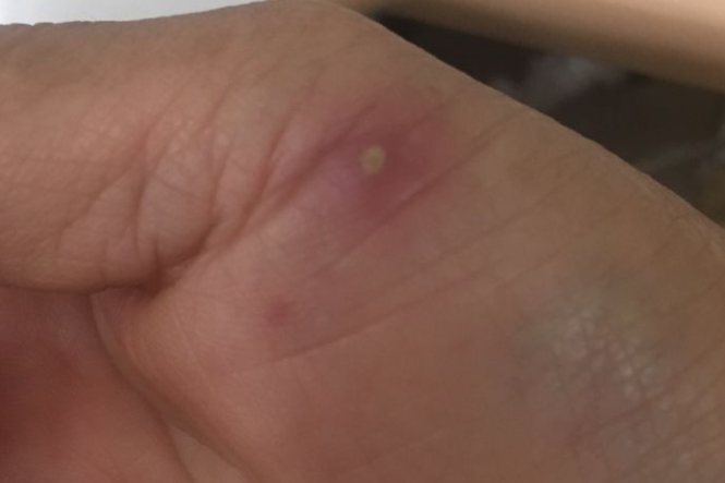 猫抓病的红斑丘疹