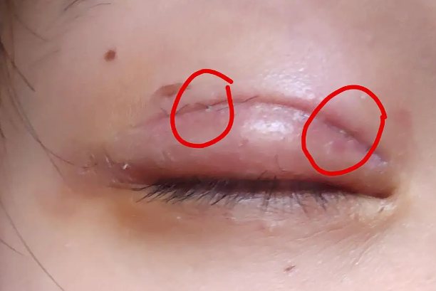 双眼皮线结反应图片