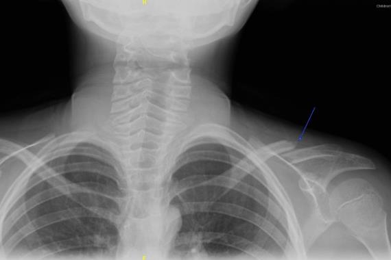 锁骨骨折自然恢复早期