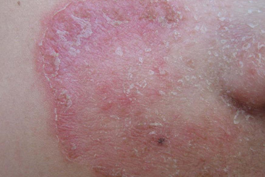 像结痂一样的癣