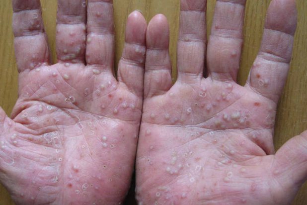 手掌脓疱疹