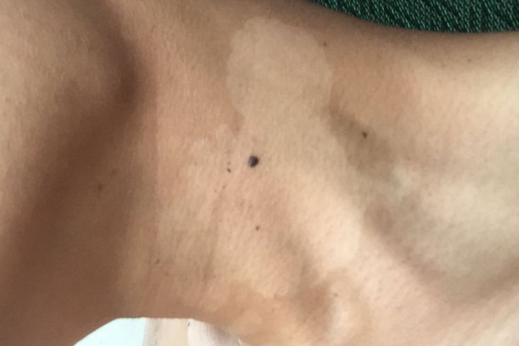 脖子上的花斑癣