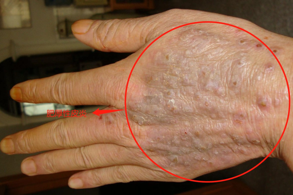 肥厚性皮炎