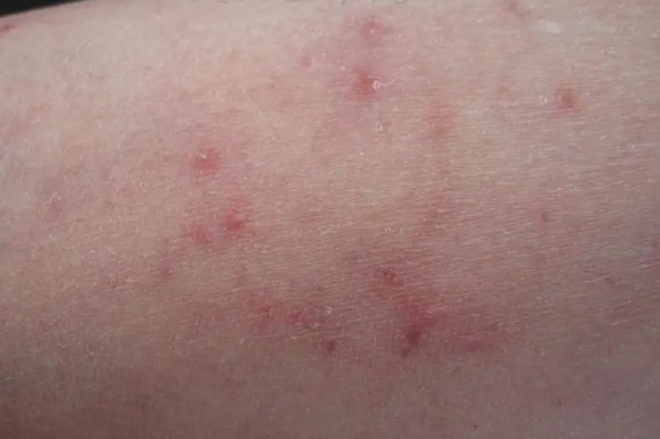 早期真菌性毛囊炎