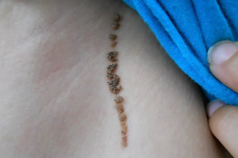 炎症性线形胎生疣状痣