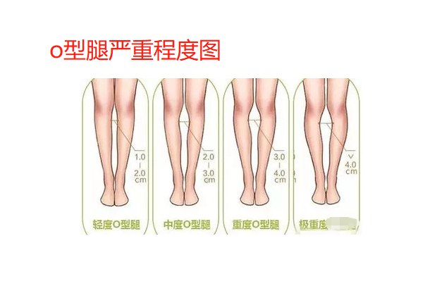 o型腿严重程度图