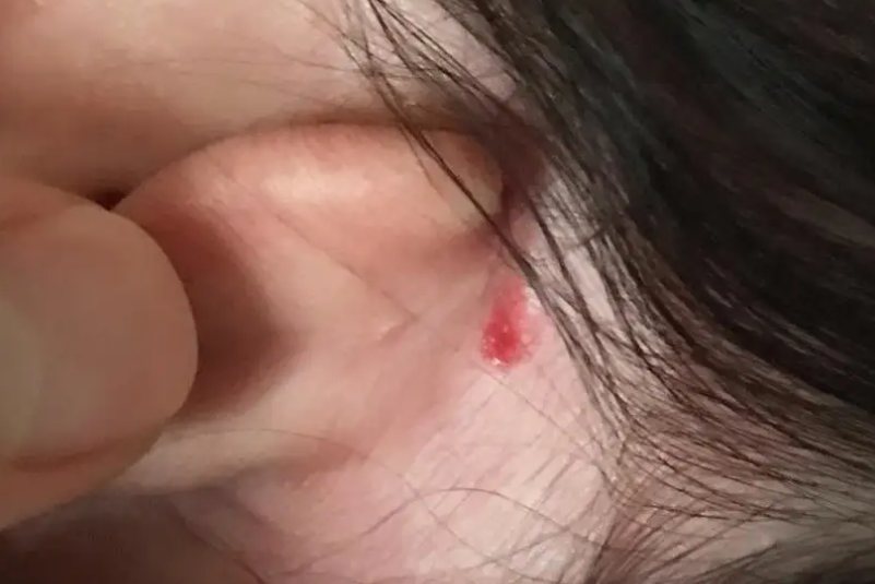 毛细血管瘤
