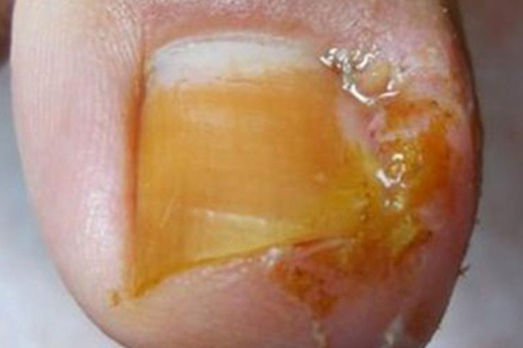 脚趾急性甲沟炎图