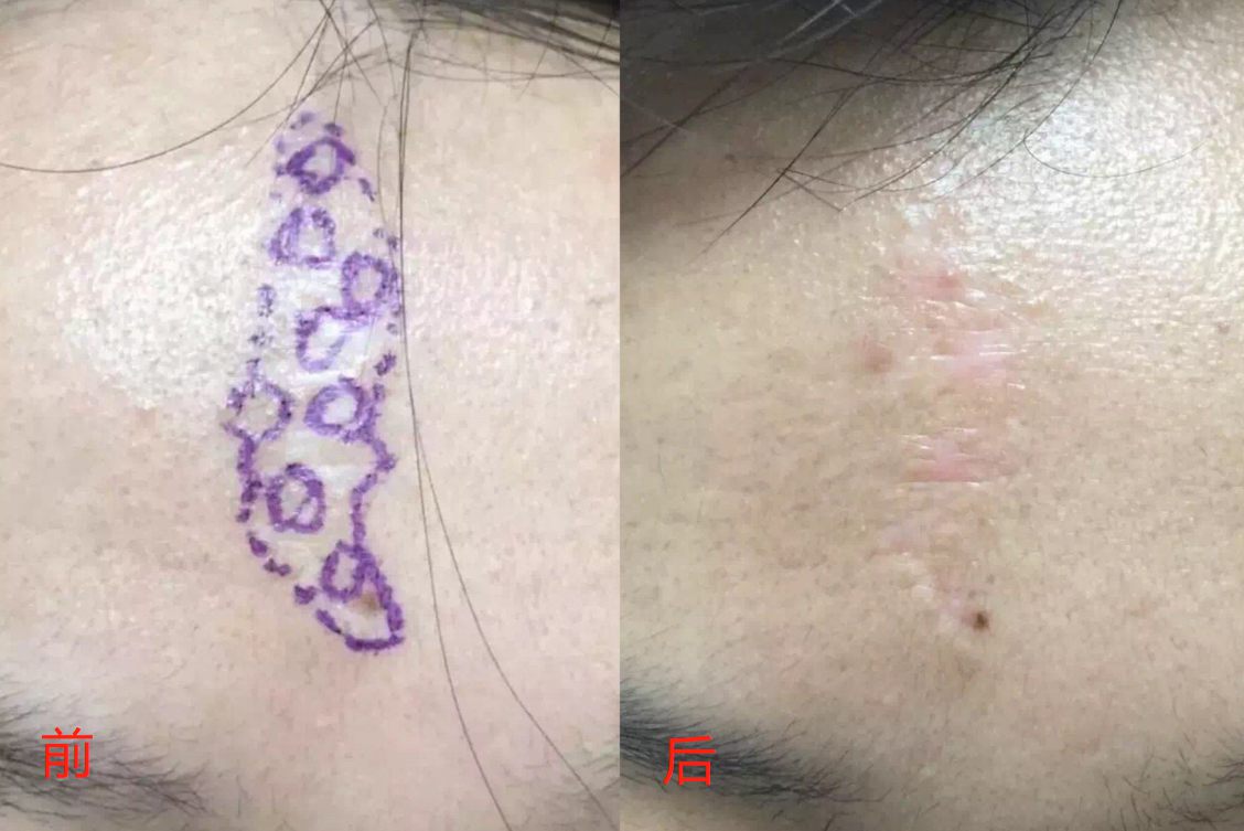 环钻切除疤痕
