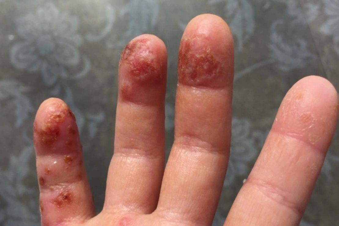 指尖湿疹