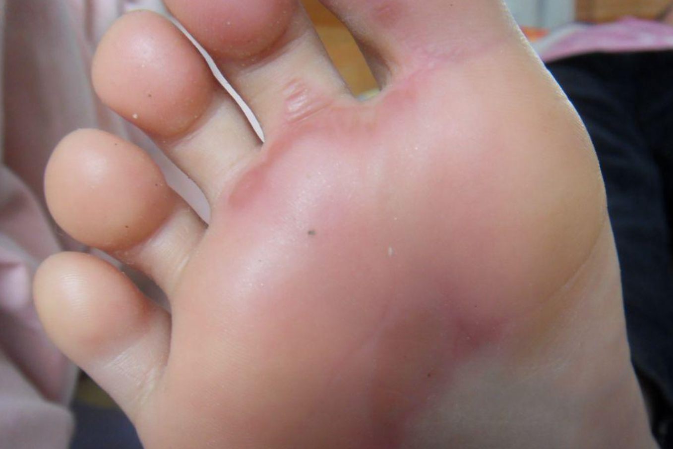 脚底过敏性皮炎