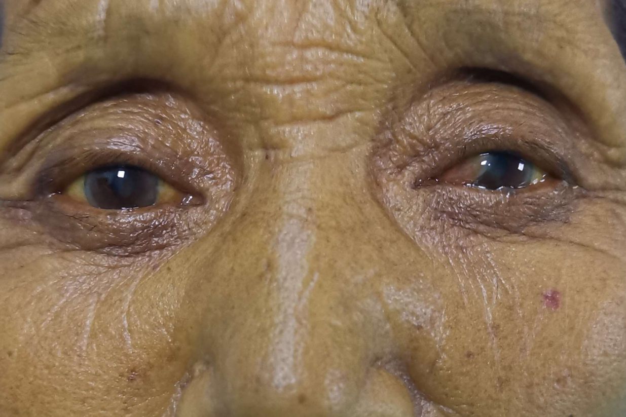 蚕豆病巩膜黄染