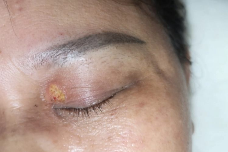 睑黄疣早期