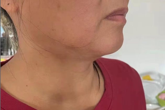 甲状腺肿大一度