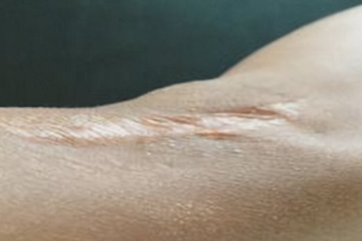 组织萎缩性凹陷疤痕