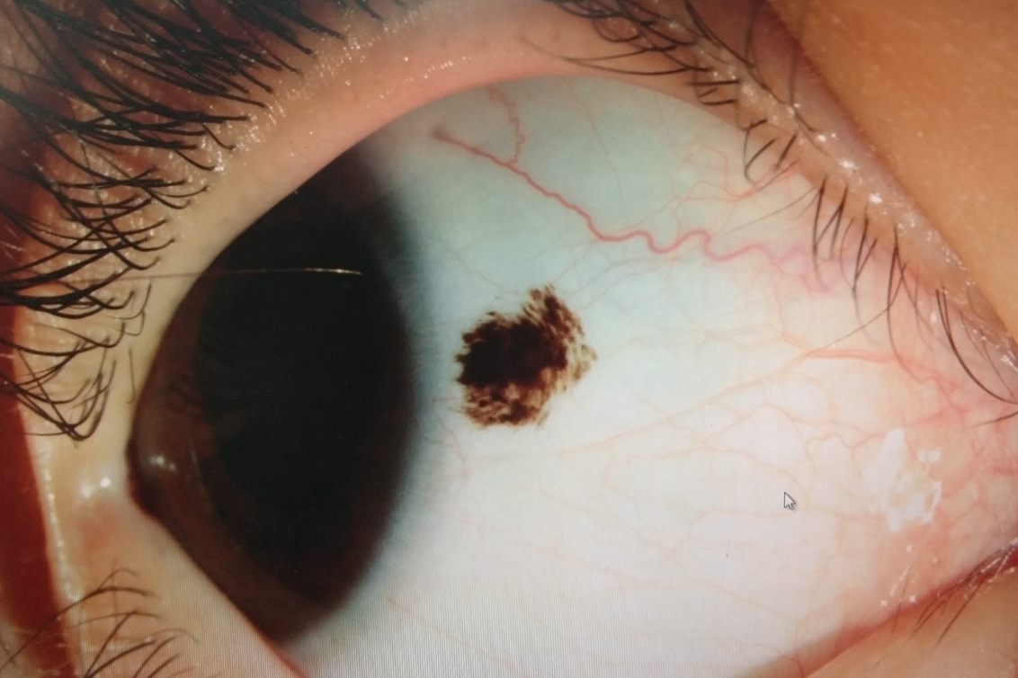 结膜色素痣