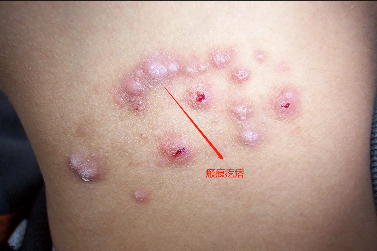 瘢痕疙瘩