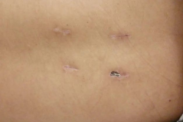 微创手术后疤痕