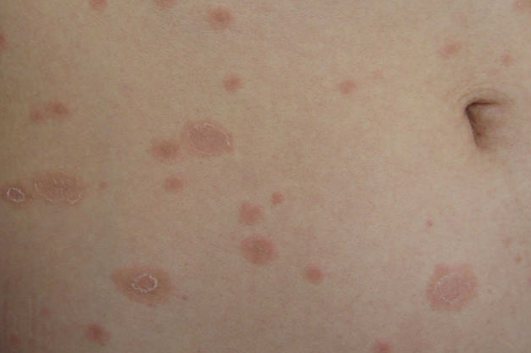 玫瑰糠疹