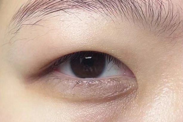 肾炎上眼皮水肿