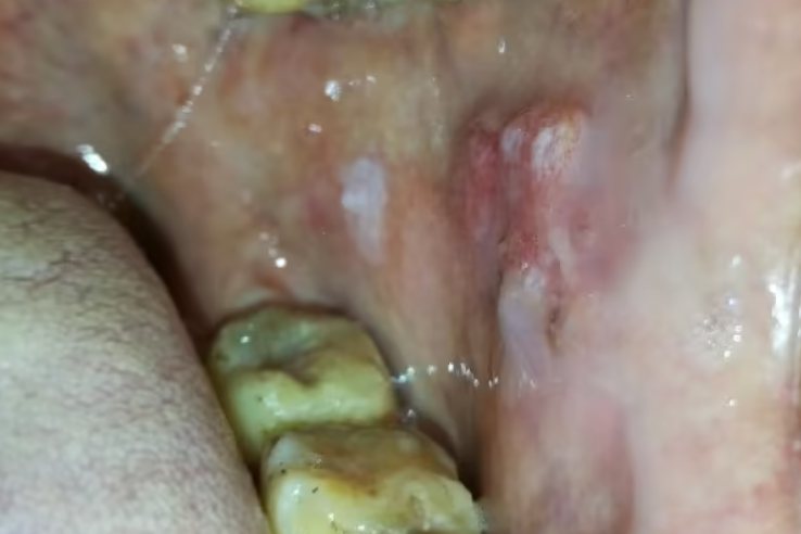 口腔鳞状细胞癌