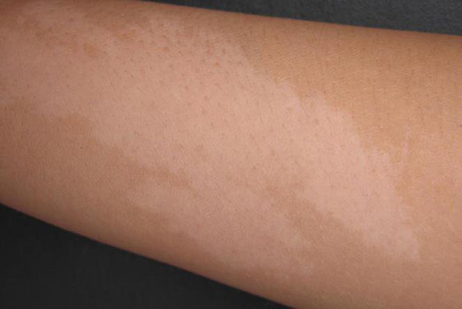 黑色素退化白斑