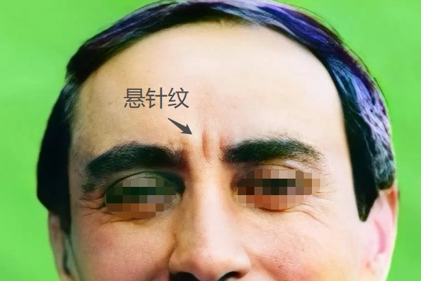 悬针纹