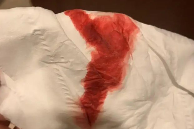 宫颈结痂脱落出血