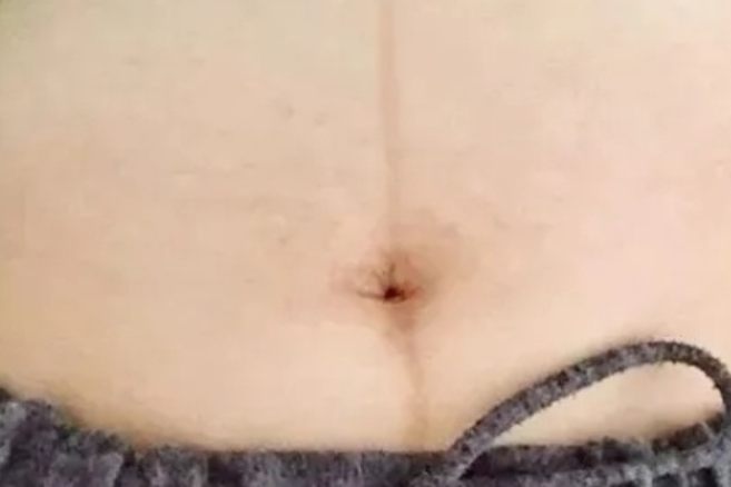 腹中线图片