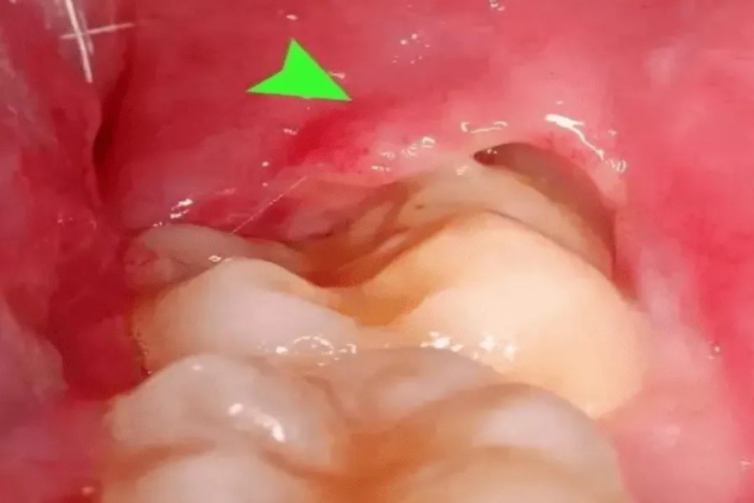 第三磨牙发炎